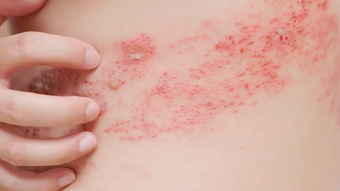 Hà Nội: Gia tăng bệnh da liễu ở trẻ em