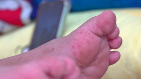 Miền Tây ghi nhận hơn 10.000 ca tay chân miệng