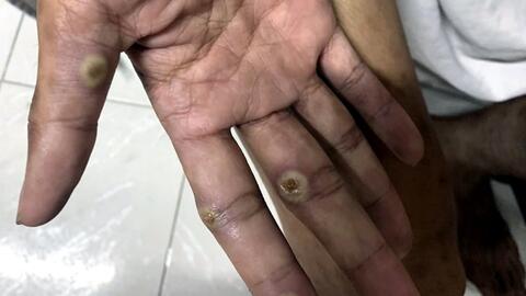 Đồng Nai xuất hiện ca đậu mùa khỉ chưa rõ nguồn lây, ngành y tế khẩn trương truy vết