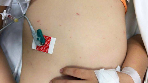 Dấu hiệu mắc não mô cầu - căn bệnh có thể tử vong trong 24 giờ