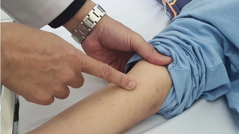 Số ca bệnh do não mô cầu tăng mạnh