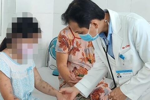 29 ca mắc bệnh thủy đậu ở khu công nghiệp, Vĩnh Long cảnh báo nguy cơ lây lan diện rộng