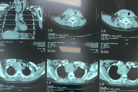 Chẩn đoán hình ảnh không cần phim in vào Quỹ BHYT chi trả