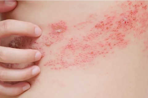 Hà Nội: Gia tăng bệnh da liễu ở trẻ em
