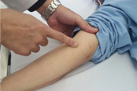 Số ca bệnh do não mô cầu tăng mạnh