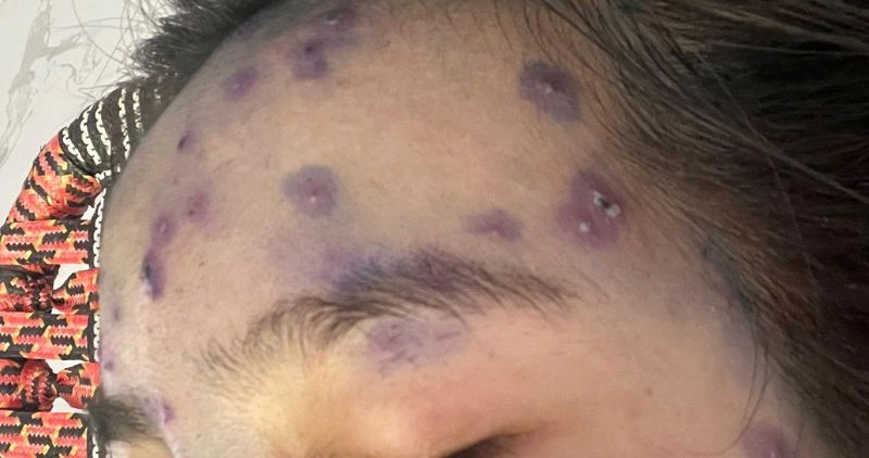 Các nốt mụn nước xuất hiện trên khuôn mặt bệnh nhân. Ảnh: Hoàng Lộc