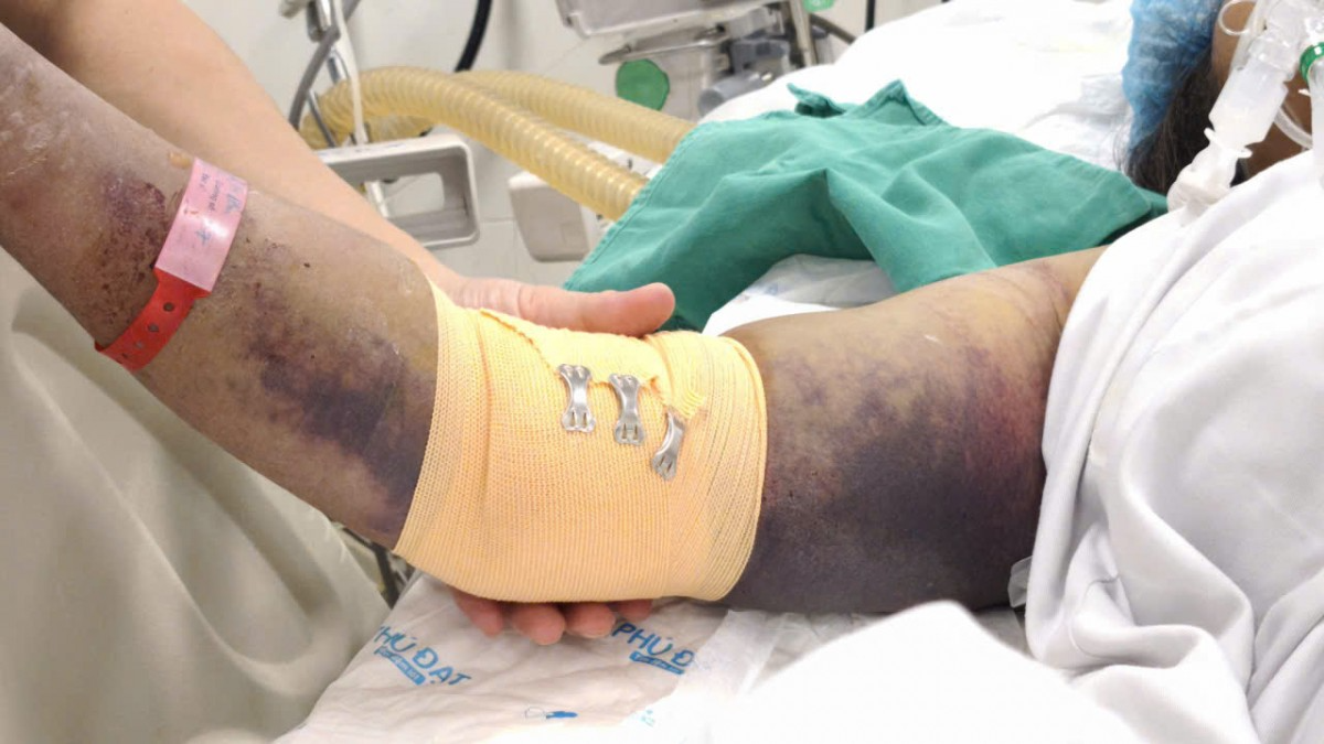 Hà Nội ghi nhận thêm 120 ca sốt xuất huyết tại 67 phường, xã